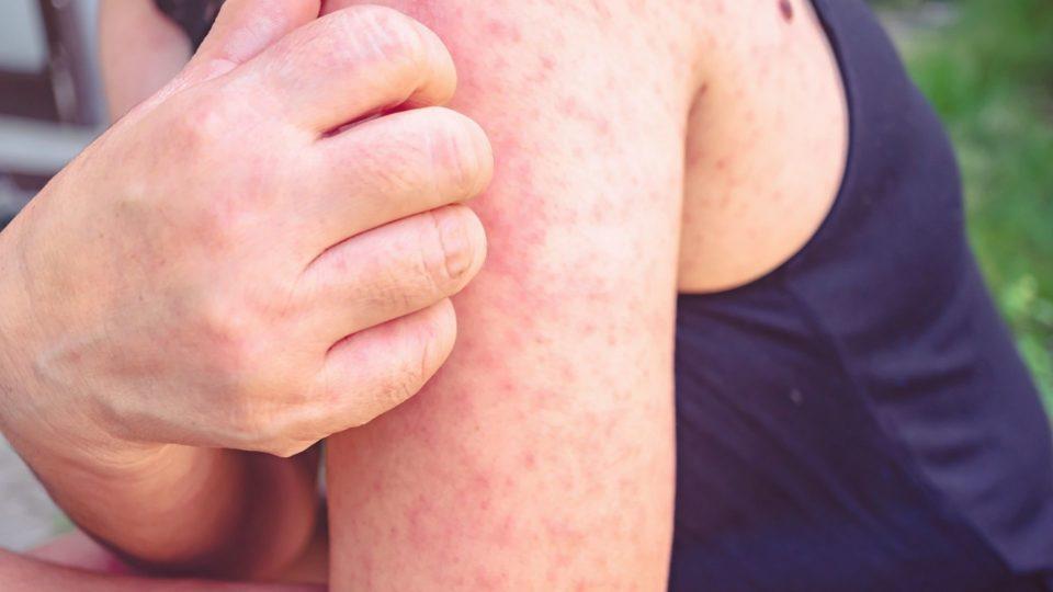 alergia-emocional-960x540-1