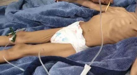 crianca-da-entrada-em-hospital-com-sinais-de-desnutricao-05062023110331204