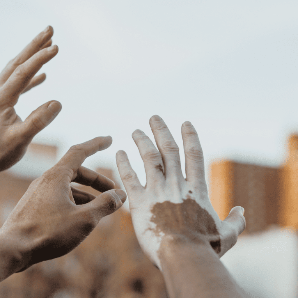 Vitiligo: SES-AM faz alerta para alto número de casos no estado
